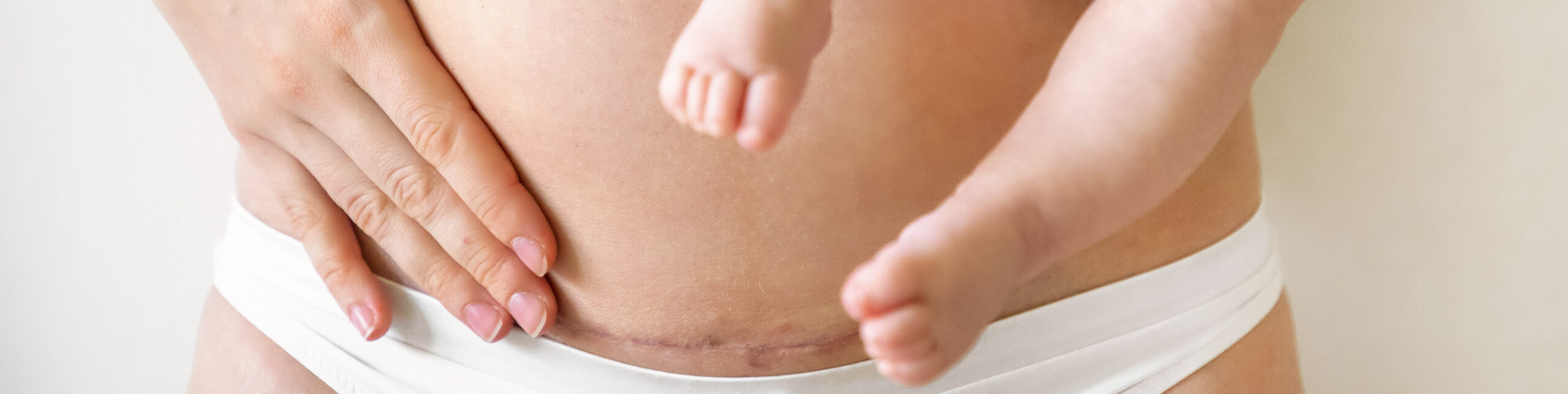 Closeup of woman belly with a scar from a cesarean section. Woman with baby on her hand